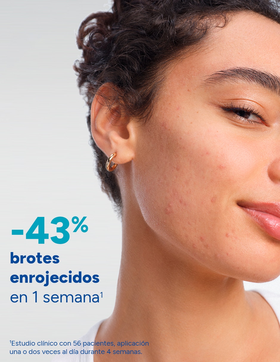 Limpiador capilar keracnyl Ducray para acné